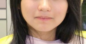 矯正治療後