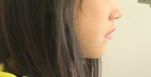 矯正治療後
