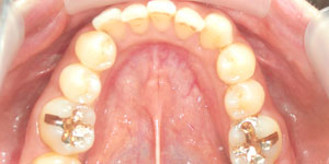 矯正前の歯並び
